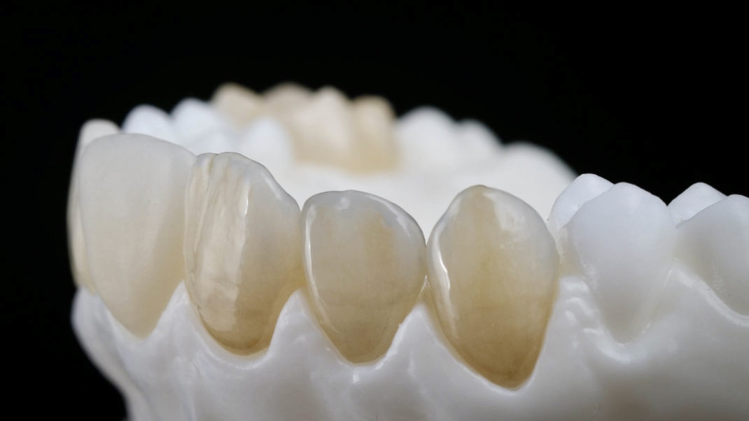 Hand-layered porcelain dental crown on a model