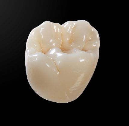 IPS e.max Restorations