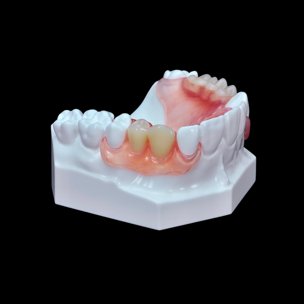 Valplast Flexible Partials